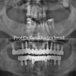 Before and after replacing a missing teeth