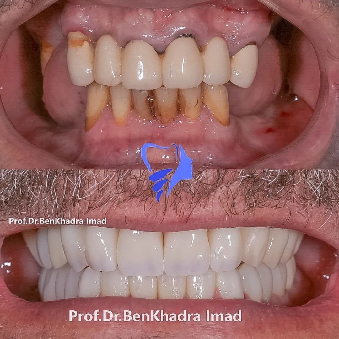 Smile makeover dr ben khadra imad german syrian dental clinic dental implant