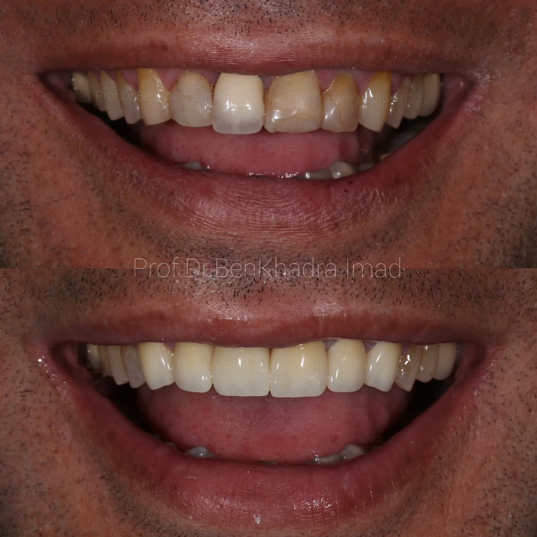 Before and after dental crowns restoring worn-down teeth in rabat Morocco.