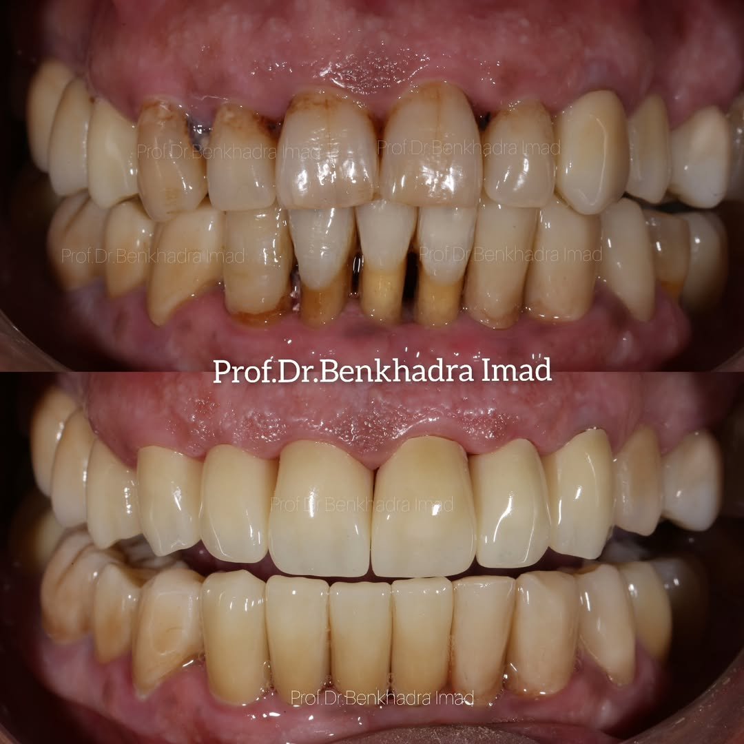 Before and after full-mouth dental crowns for a complete smile transformation.