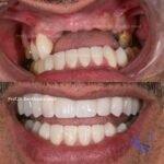 Before and after upper jaw dental implants for a restored smile.