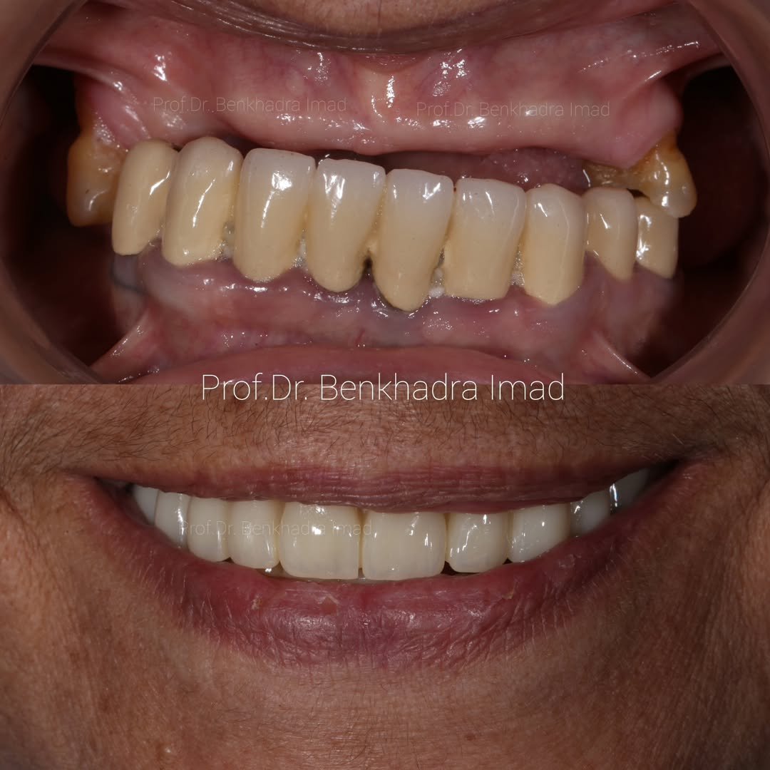 Before and after full-mouth dental implants restoring missing teeth in rabat, Morocco