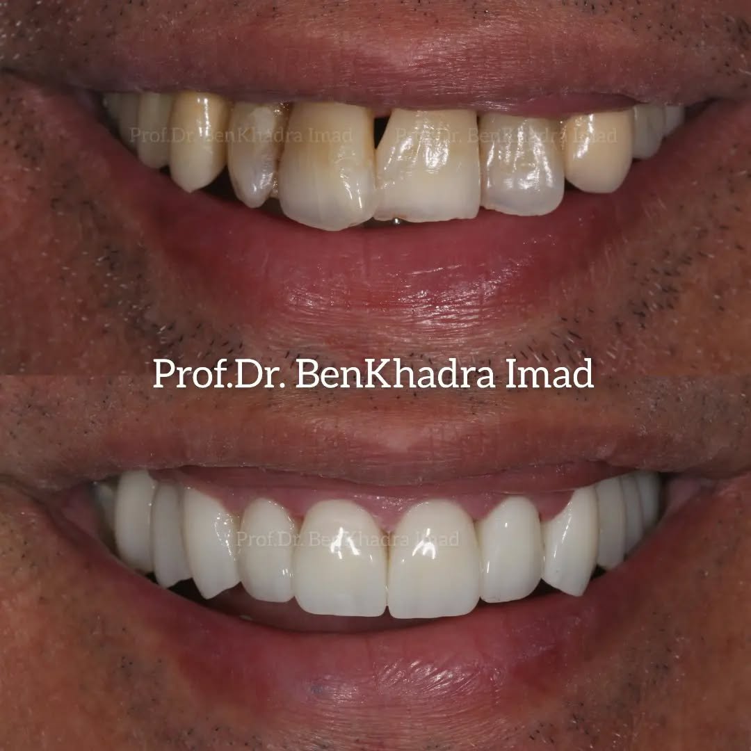 Before and after zirconia dental crown restoring a cracked tooth in Rabat.