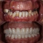 Before and after dental implant case – missing teeth replaced with natural-looking implants in Rabat, Morocco