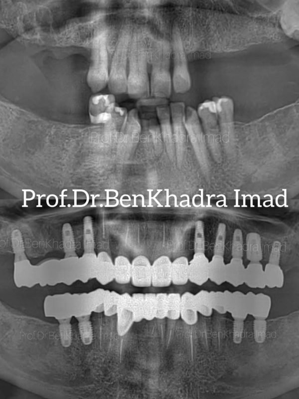 Before and after replacing a missing teeth