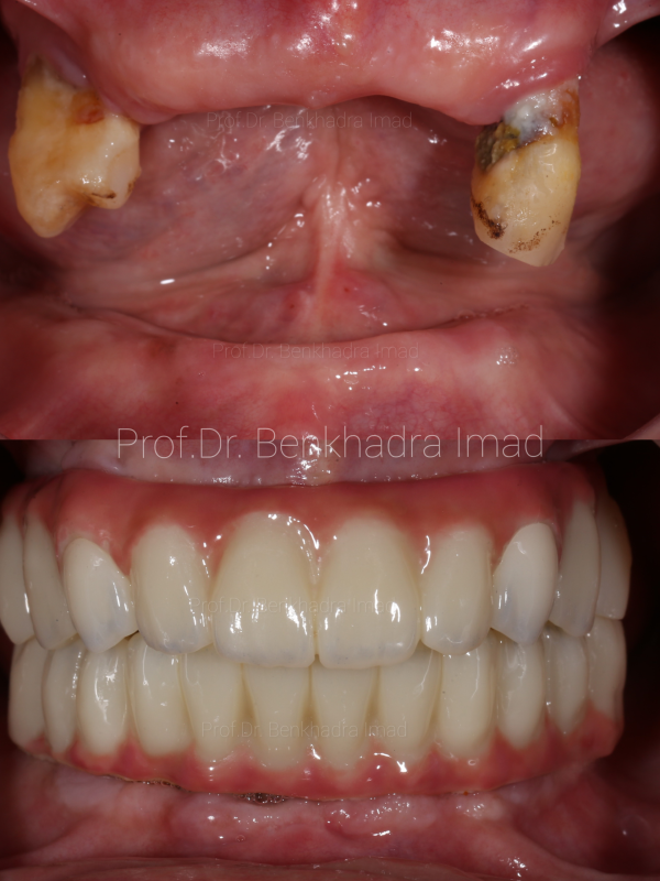 full mouth rehabilitaion