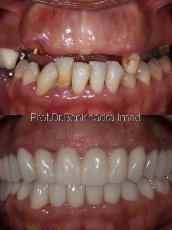 Before and after dental implant case – missing teeth replaced with natural-looking implants in Rabat, Morocco